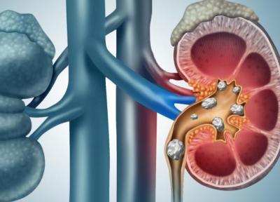 چه عواملی کلیه را سنگ ساز می کند؟ چه عواملی کلیه را سنگ ساز می کند؟
